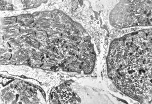 M,4m. | rhabdomyosarcoma in retented testis M,4m. | rhabdomyosarcoma in retented testis